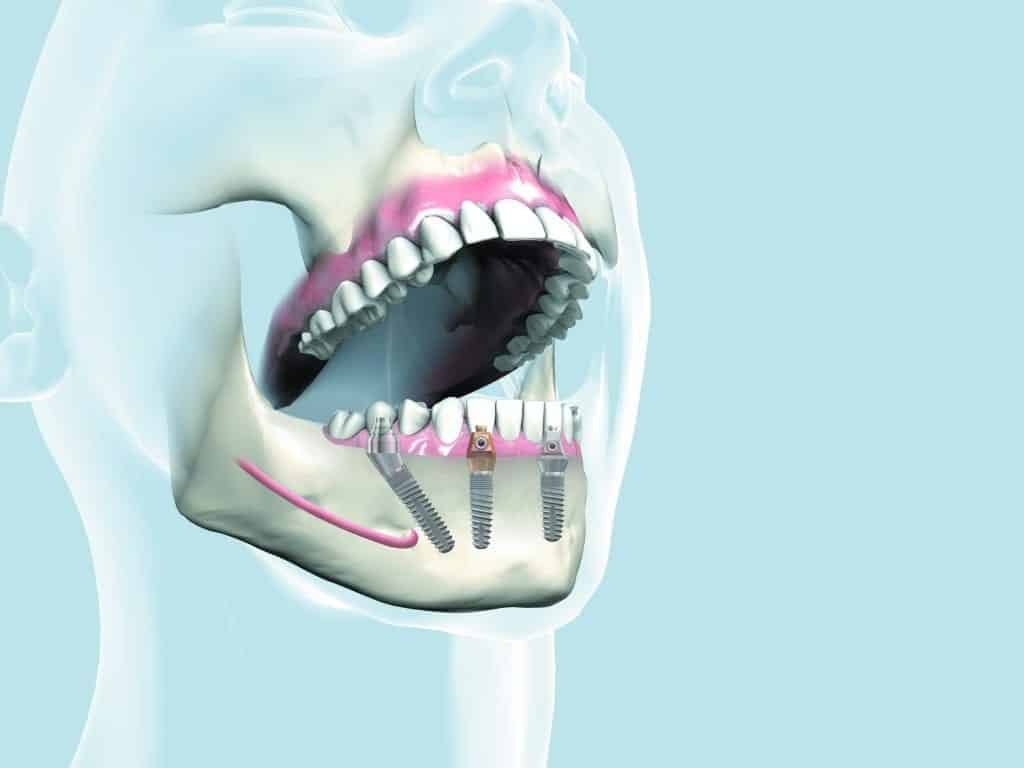 What affects the lifespan of dental implants?