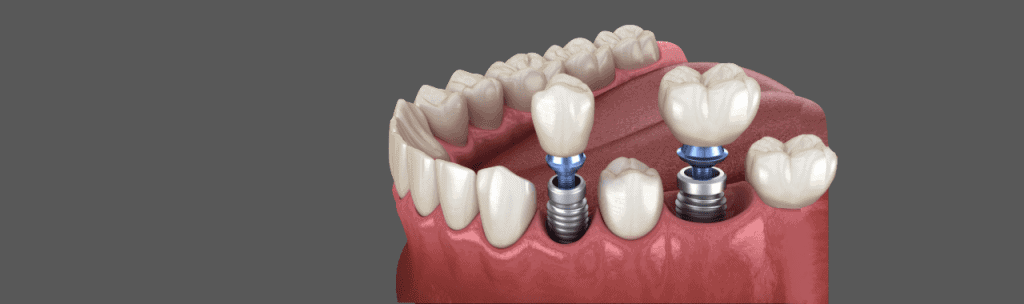 Are dental implants painful? - Revitalise Dental Centre