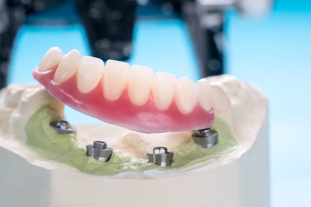 Implant retained dentures - Revitalise Dental Centre