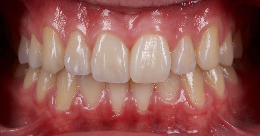 Cosmetic Dentistry - Case One - After