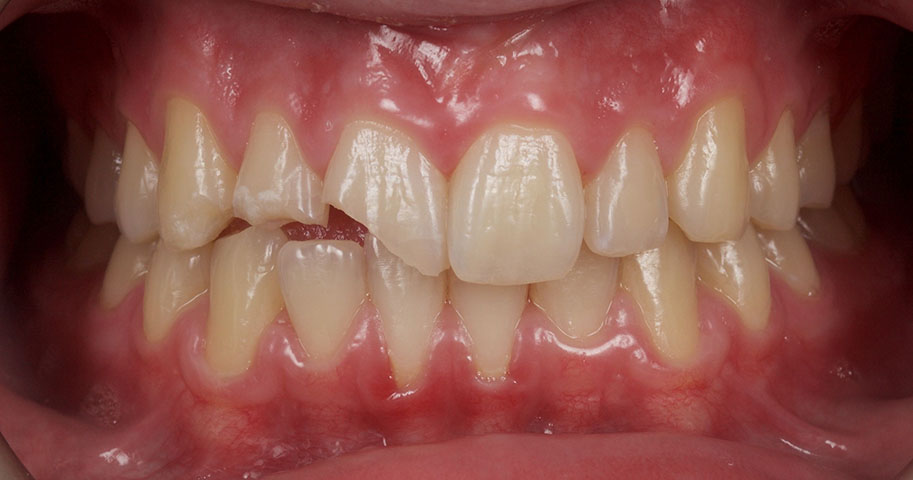 Cosmetic Dentistry - Case One - Before