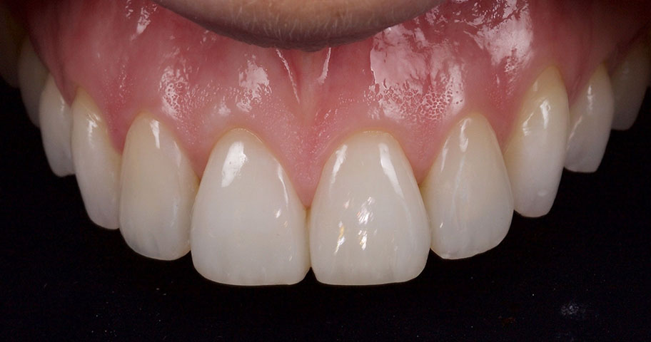 Cosmetic Dentistry - Case Two - After