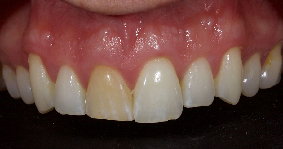 Cosmetic Dentistry - Case Two - Before
