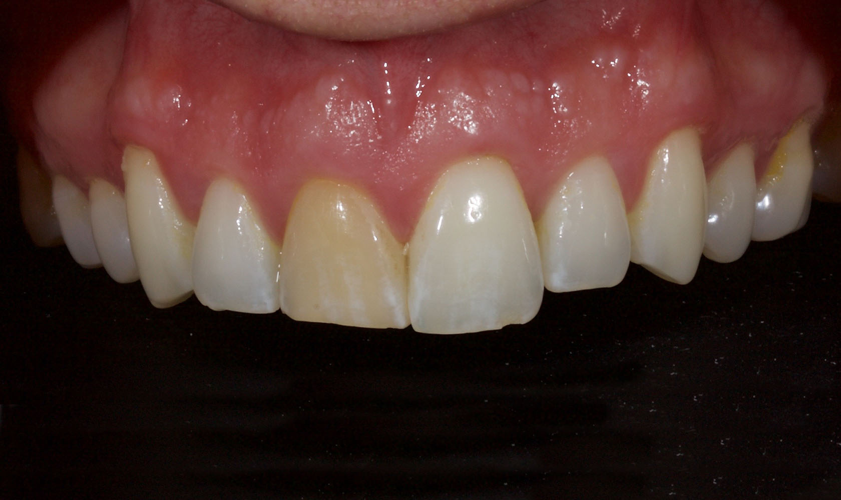 Tooth Whitening - Before