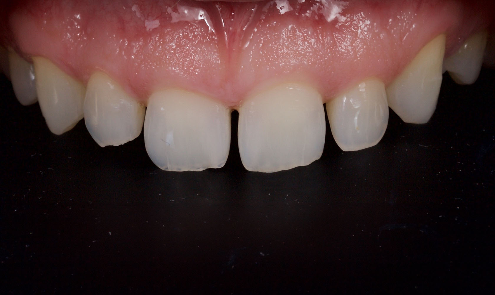 Orthodontics - Before - 1