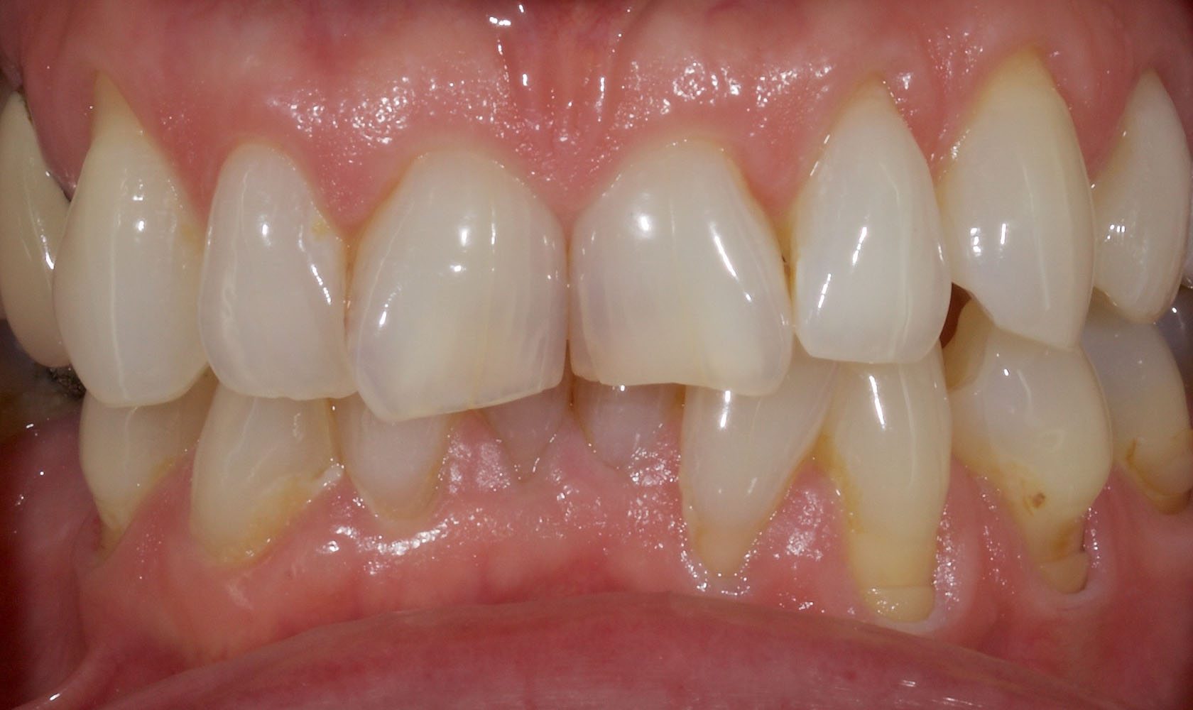 Orthodontics - Before